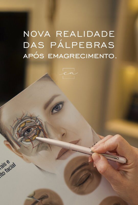 blefaroplastia-apos-emagrecimento-monjaro-dra-carolina-angeloni-blefaroplastia-cuiaba-mato-grosso