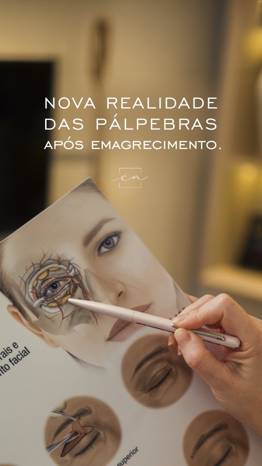 blefaroplastia-apos-emagrecimento-monjaro-dra-carolina-angeloni-blefaroplastia-cuiaba-mato-grosso