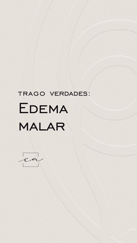 tratamento-edema-malar-festoon-oculoplastica-cuiaba-mt